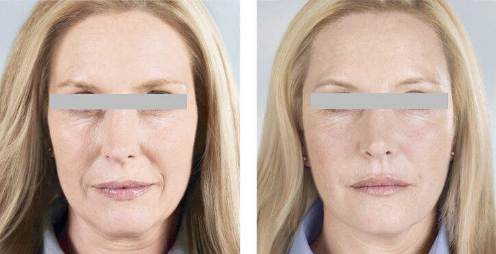 sculptra-rejuvenecimiento-facial-clinicas-dh